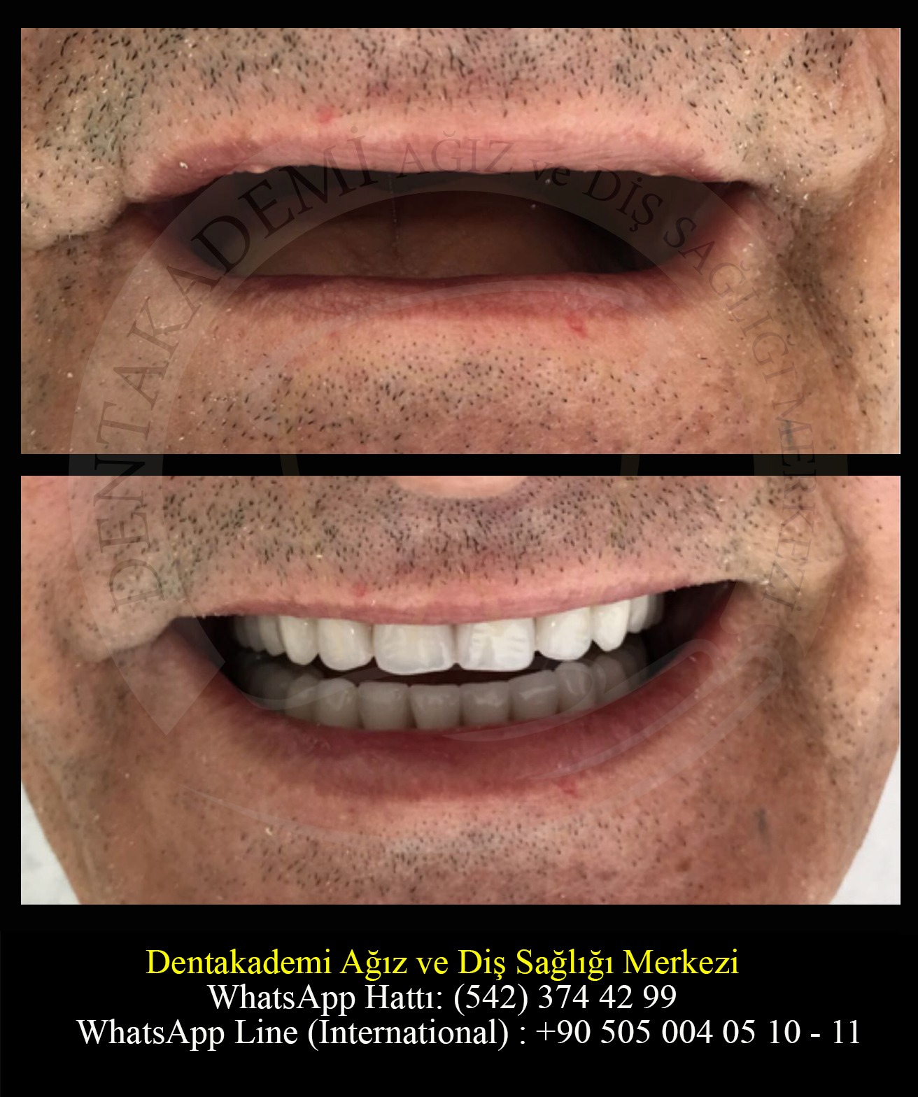 Blanchiment Dentaire